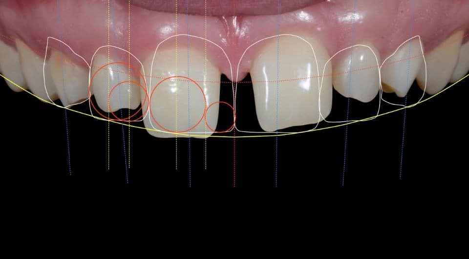 digital smile design