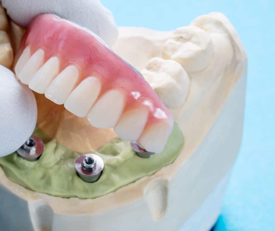 Prikaz dentalnih implantata u čeljusti s postavljenim fiksnim mostom na modelu