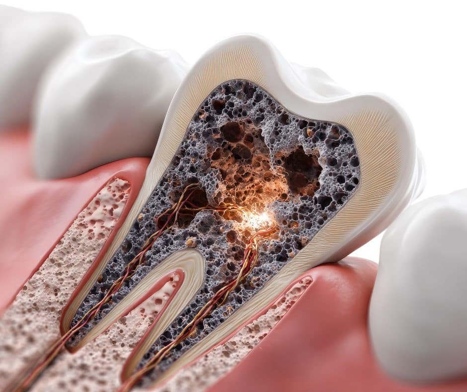 Prikaz presjeka zuba s oštećenjem dentina i pulpe zbog erozije cakline