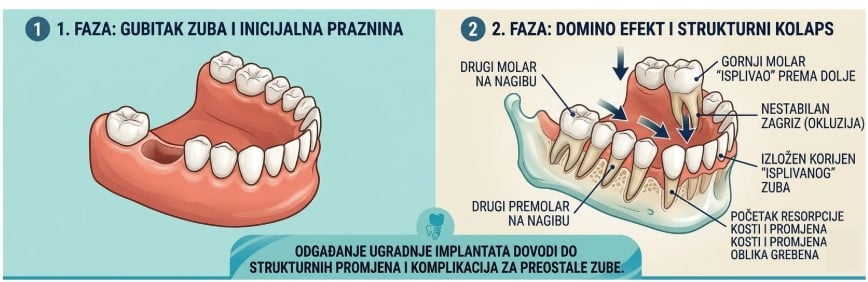Kako gubitak jednog zuba mijenja cijeli zagriz