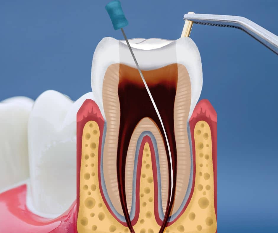 Anatomski prikaz ciscenja korijenskog kanala endodontskim instrumentom