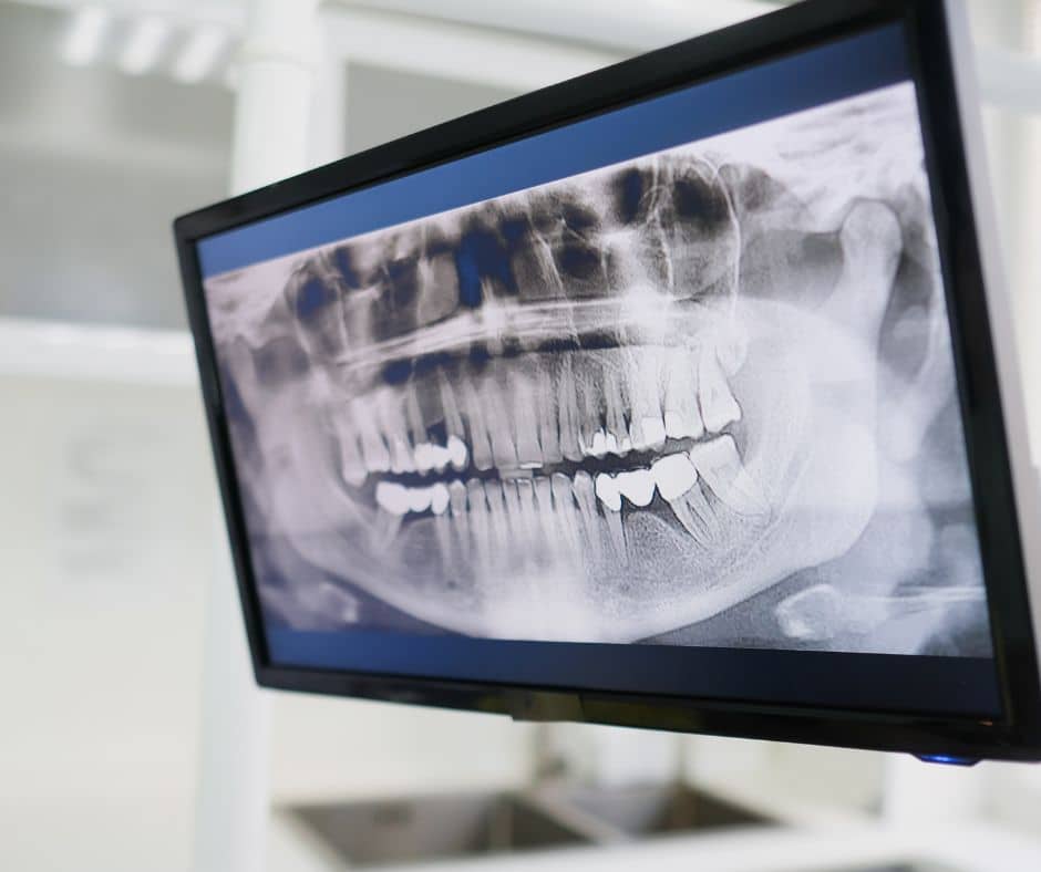 Digitalna RTG snimka zubi (ortopan) na ekranu u stomatološkoj Poliklinici Smile