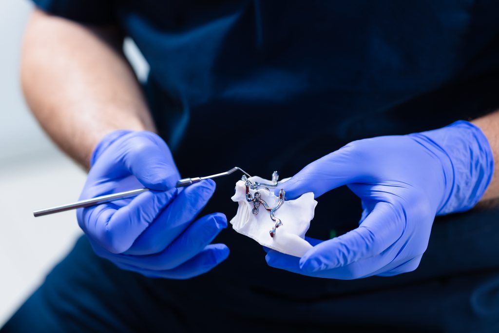 3D model atrofirane čeljusti s prilagođenim No Bone titanijskim okvirom u rukama stomatologa.
