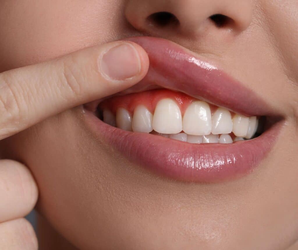 Krupni plan natečenih i upaljenih desni koje ugrožavaju parodontno zdravlje i ukazuju na rizik od bakterijemije.