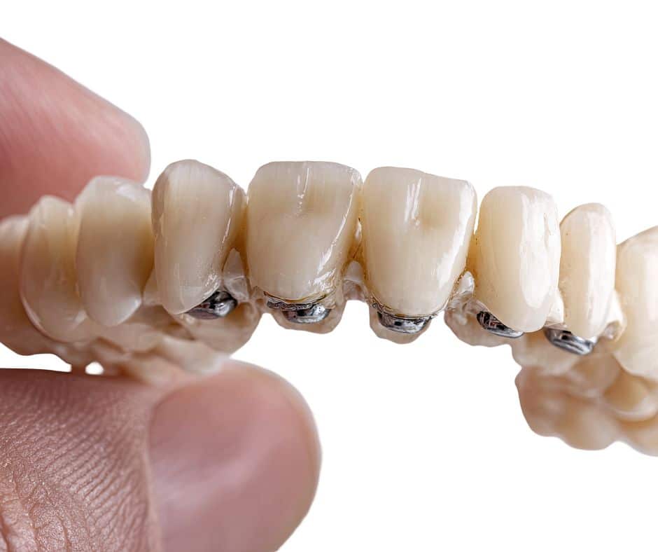 Prikaz zubnog mosta izbliza i spojeva krunica za oralnu higijenu