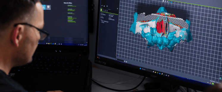Progettazione 3D della protesi al computer